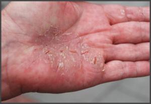 psoriasis of the hands